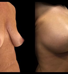 Изменение формы груди